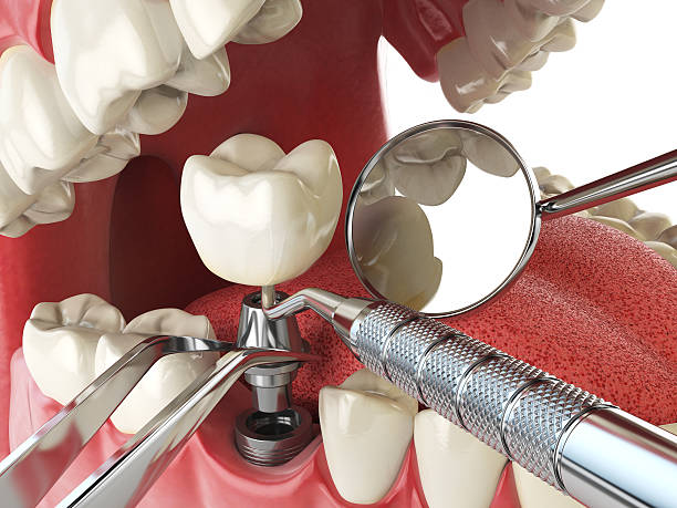 Best Emergency Tooth Extraction in Marks, MS